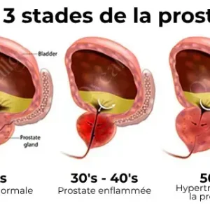 Oveallgo™ BeeBoom – Inhalateur nasal pour soutenir le bien-être de la prostate